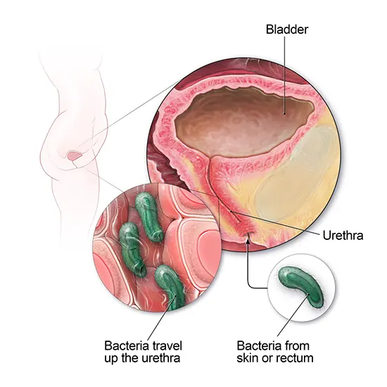 Urinary Tract Infection (UTI):  Symptoms, Causes & Treatment